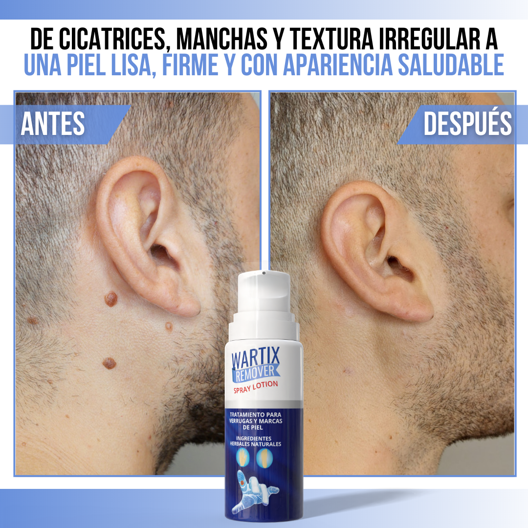 WARTIX REMOVER™ - Elimina verrugas y lunares con rapidez