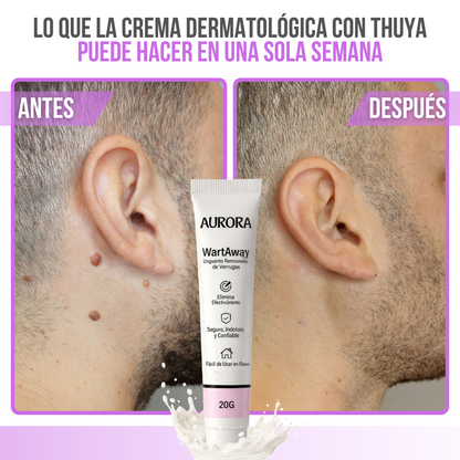 Wart Away™ Crema Eliminadora de Verrugas y Fibromas